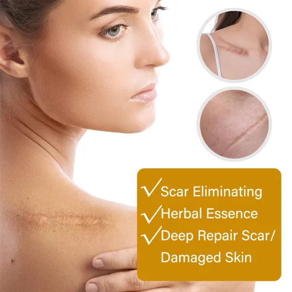Acne Scar Removal Rejuvenation Serum | Scar, C Section & Stretch Mark Removal Oil For Women - Image 4